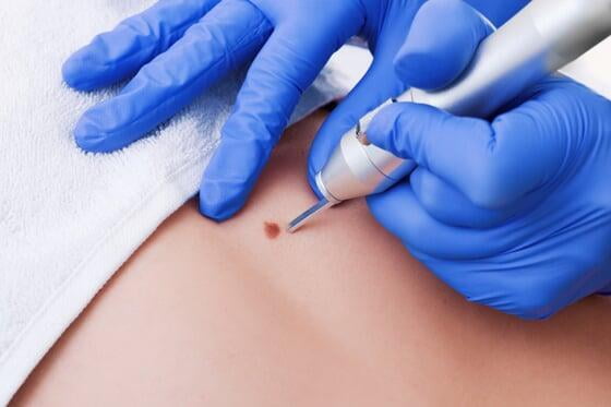 Retiro de verrugas por papiloma y molusco contagioso con láser